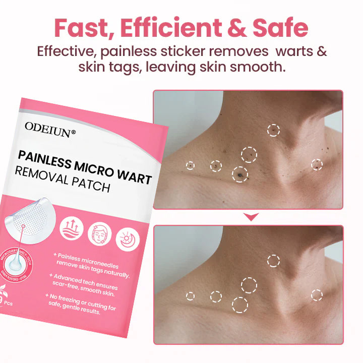 Painless Micro Wart Removal Patch