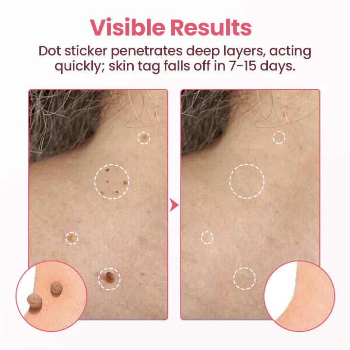 Painless Micro Wart Removal Patch