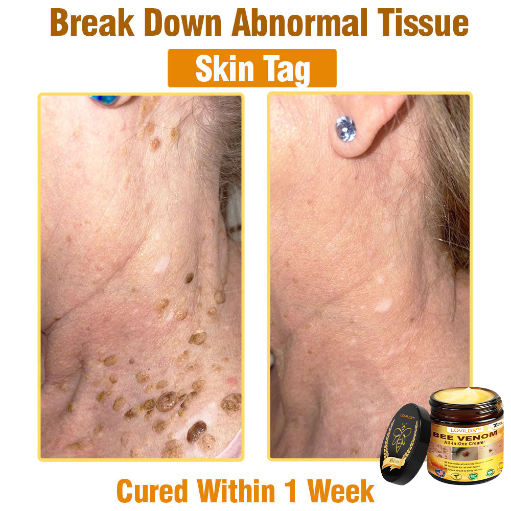 LOVILDS™ Bee Venom All-in-One Cream US Dermatologist Approved